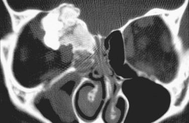 Fig. 6-15, Osteoblastoma.