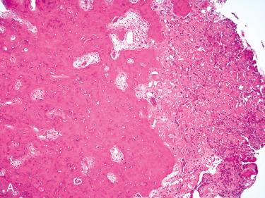 Fig. 6-16, Osteoblastoma.