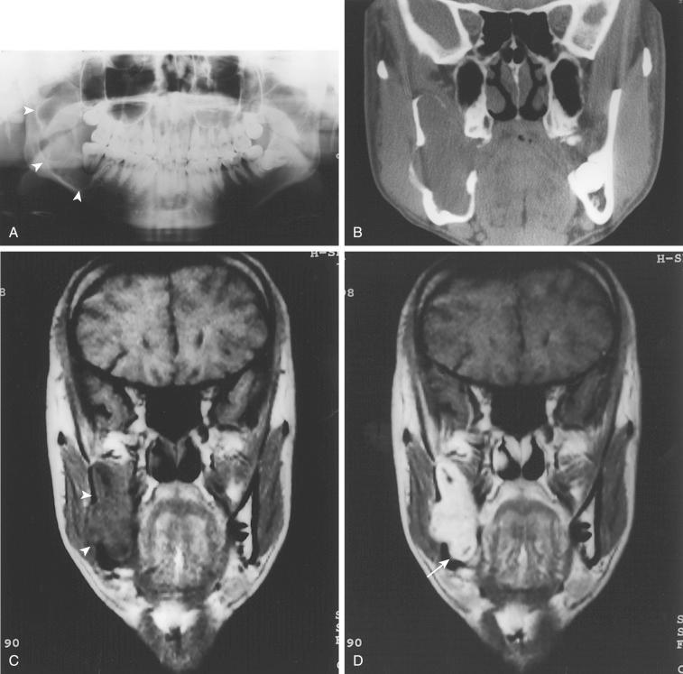 Fig. 6-17, Ameloblastoma.