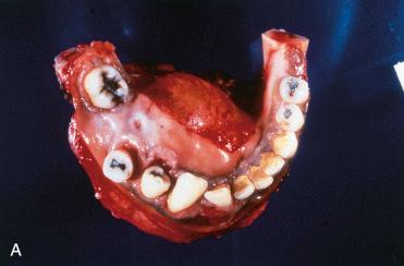 Fig. 6-18, Ameloblastoma, follicular (solid and cystic) variant.