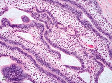 Fig. 6-19, Histology of ameloblastoma.