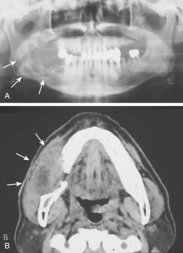 Fig. 6-20, Ameloblastic carcinomas of the mandible in 28-year-old woman.