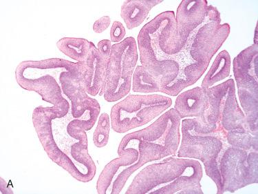 Fig. 6-2, Histology of squamous papilloma.