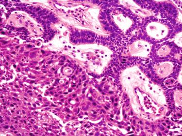 Fig. 6-21, Ameloblastic carcinoma.