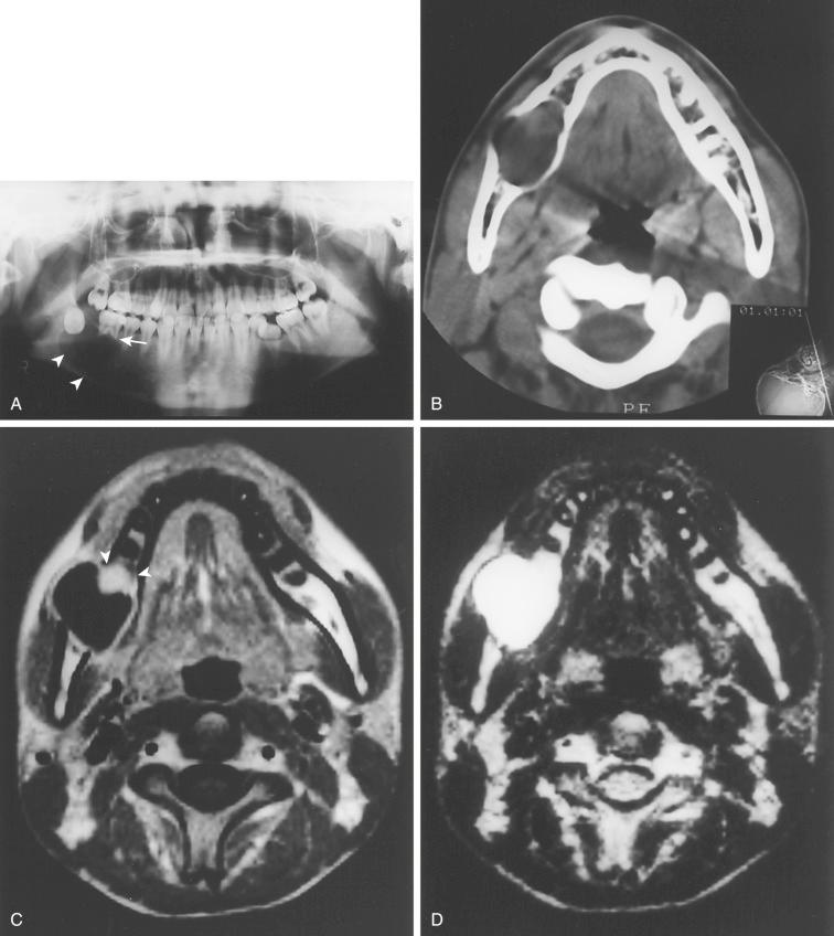 Fig. 6-23, Ameloblastoma, unicystic type.