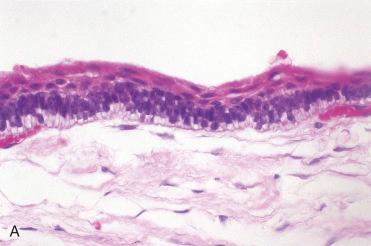 Fig. 6-24, Ameloblastoma, unicystic type.