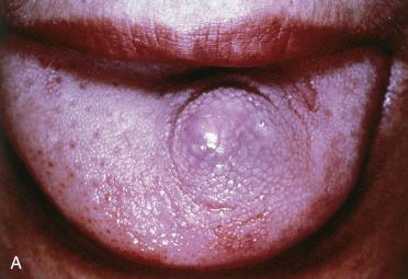 Fig. 6-3, Ectomesenchymal chondromyxoid tumor of the anterior tongue.