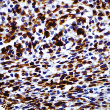 Fig. 6-4, Immunohistochemical reactivity in ectomesenchymal chondromyxoid tumor.