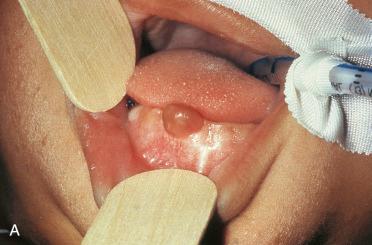 Fig. 6-5, Congenital granular cell epulis.