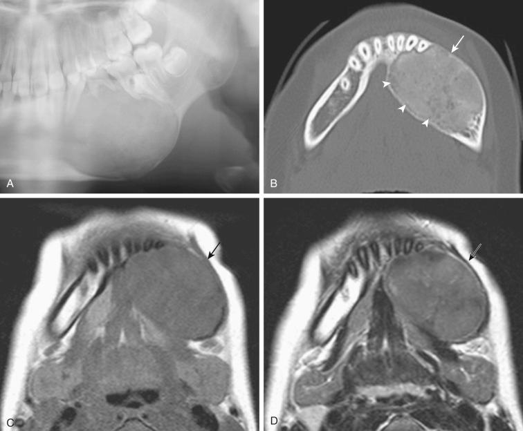 Fig. 6-9, Ossifying fibroma in the mandible.