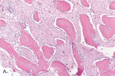 Fig. 6-10, Ossifying fibroma.