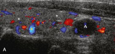 Fig. 33-1, Classic parathyroid adenoma identified on ultrasonography.