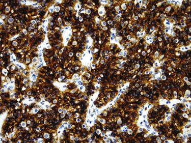 Fig. 33-11, IHC staining in parathyroid adenoma.