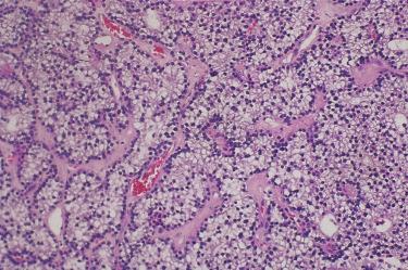 Fig. 33-12, Parathyroid adenoma.