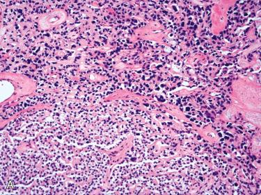 Fig. 33-14, A, Parathyroid adenoma composed of uniform and bland-appearing nuclei in lower portion of image as well as numerous large cells with hyperchromatic nuclei; intralesional fibrosis is also present. B, Bizarre-appearing pleomorphic and hyperchromatic nuclei admixed with bland-appearing nuclei. Such findings in the absence of increased mitotic activity and/or other features associated with parathyroid carcinoma can be seen in parathyroid adenomas.