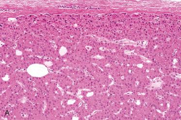 Fig. 33-18, Oncocytic parathyroid adenoma.