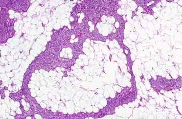 Fig. 33-19, Parathyroid lipoadenoma.