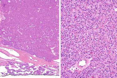 Fig. 33-20, Parathyroid adenoma associated with osteitis fibrosa cystica.