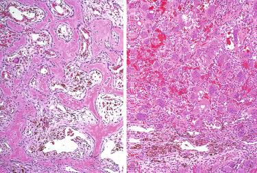 Fig. 33-21, Brown tumor of hyperparathyroidism.