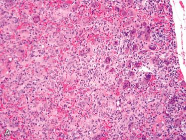 Fig. 33-22, Brown tumor of hyperparathyroidism.