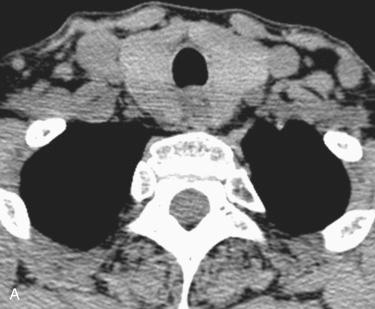 Fig. 33-3, 4D-CT in the detection of a small adenoma.