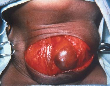 Fig. 33-4, Parathyroid adenoma.