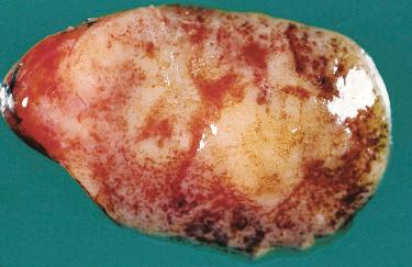 Fig. 33-5, Parathyroid adenoma.