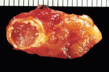 Fig. 33-6, Parathyroid adenoma.