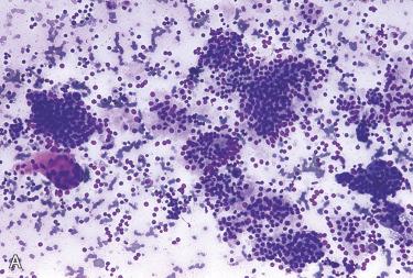 Fig. 33-7, Parathyroid adenoma, fine-needle aspiration.