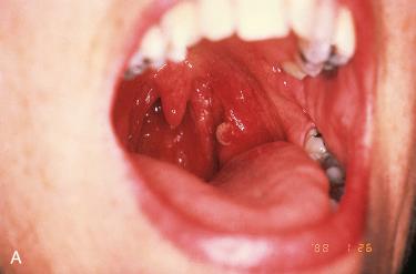 Fig. 10-1, Squamous papilloma of the pharynx.