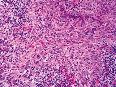 Fig. 10-14, NPC, variant histology.