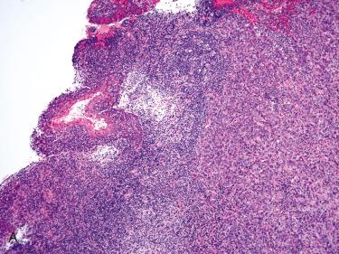 Fig. 10-15, Example of HPV-associated nasopharyngeal carcinoma.