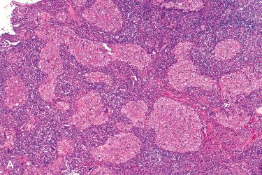 Fig. 10-11, Nasopharyngeal carcinoma, nonkeratinizing undifferentiated.