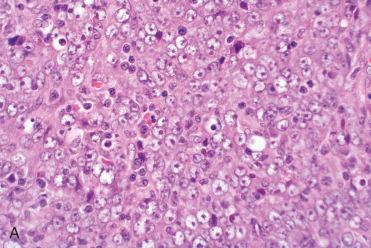 Fig. 10-12, Nasopharyngeal carcinoma, nonkeratinizing undifferentiated.