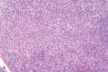 Fig. 10-13, Nasopharyngeal carcinoma, nonkeratinizing undifferentiated.