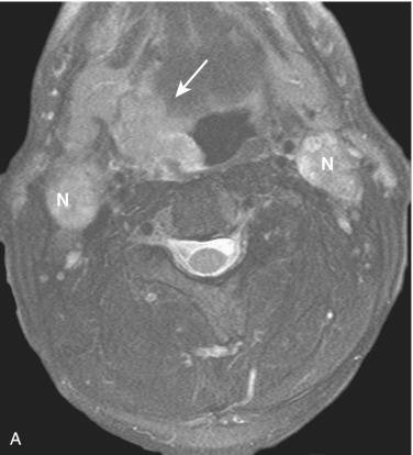 Fig. 10-17, Radiologic imaging in tonsillar carcinoma.