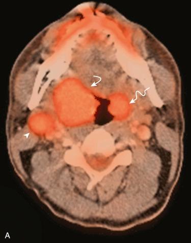 Fig. 10-18, PET/CT scan in tonsillar carcinoma.