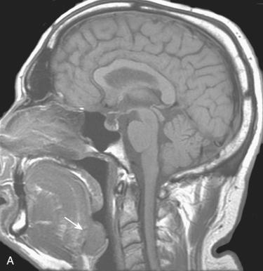 Fig. 10-19, Radiologic imaging in base of tongue carcinoma.