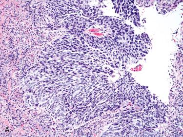 Fig. 10-22, In-situ versus invasive oropharyngeal HPV-associated SCC.