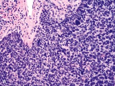 Fig. 10-23, Tumor cell anaplasia in oropharyngeal HPV-associated SCC.