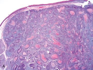 Fig. 10-20, Histology of orophayngeal HPV-associated SCC.