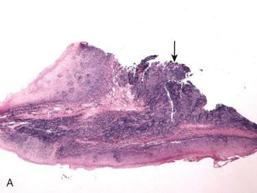 Fig. 10-21, Biopsy of base of tongue HPV-associated SCC.