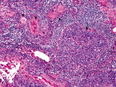 Fig. 10-24, Hybrid type of oropharyngeal HPV-associated SCC.