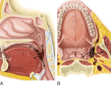 Fig. 10-25, Patterns of spread for tonsillar carcinoma.