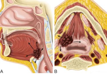 Fig. 10-26, Patterns of spread for tongue base carcinoma.