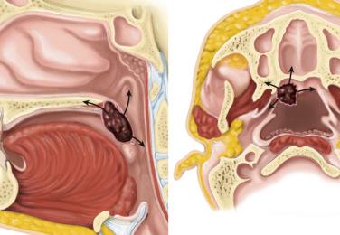 Fig. 10-28, Patterns of spread for soft palate carcinoma.