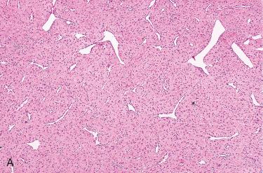 Fig. 10-4, Nasopharyngeal angiofibroma.