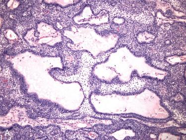 Fig. 10-5, Craniopharyngioma, adamantinomatous type.