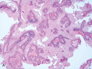 Fig. 10-6, Papillary craniopharyngioma.