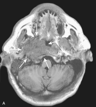 Fig. 10-7, Nasopharyngeal carcinoma.